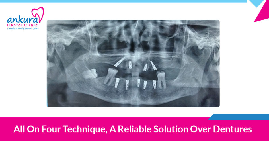 All on Four Technique, A Reliable Solution Over Dentures