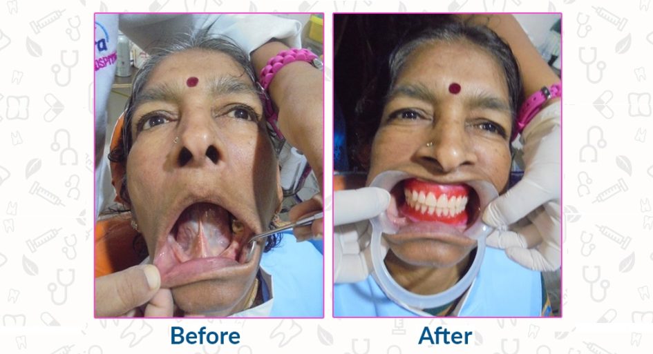 Dental Case Study The New Set of Teeth to The Patient