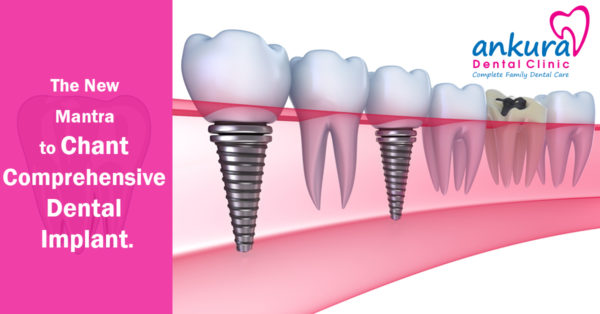 Dental implants - Best Dental Clinic Hyderabad