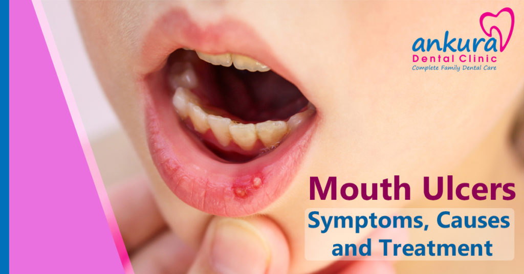 mouth-ulcers-symptoms-causes-and-treatment-mouth-sores