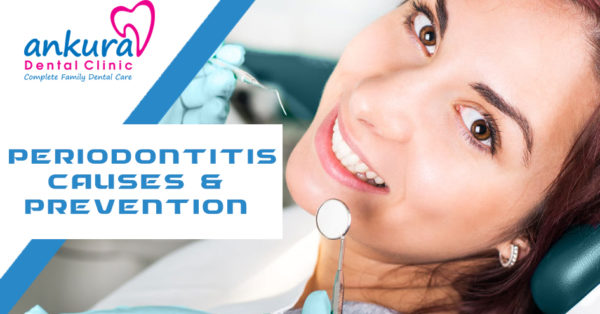 Periodontitis Causes & Prevention