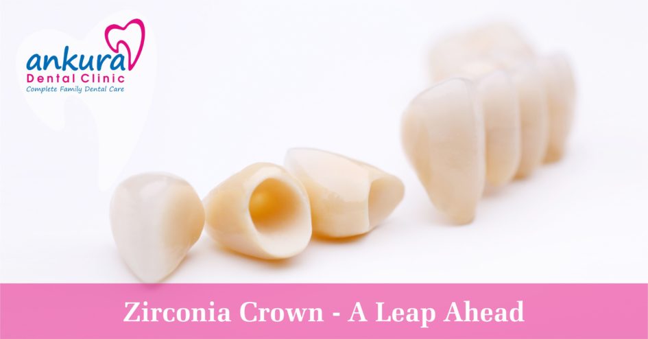 Zirconia Crown - A Leap Ahead