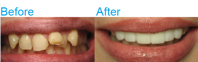 Amy-Before-and-After-Invisalign